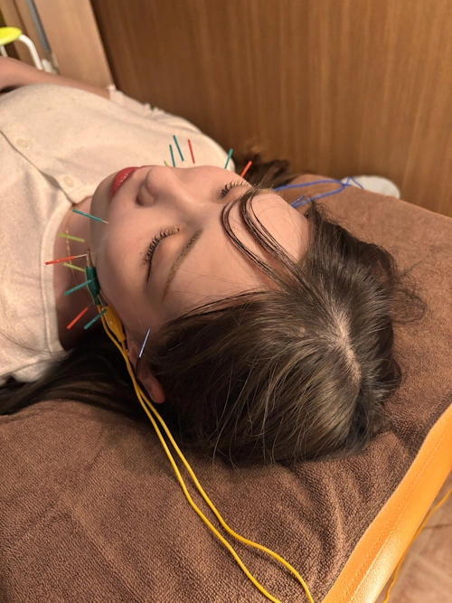 鍼灸ケアのイメージ